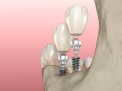 What you need to know about Conventional implants!